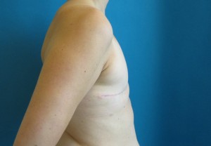 Patient before breast reconstruction using implants